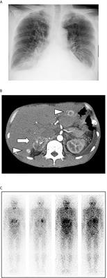 Case Report: Malignant Pheochromocytoma Without Hypertension Accompanied by Increment of Serum VEGF Level and Catecholamine Cardiomyopathy